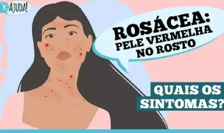 Dr. Ajuda | Saúde - Rosácea: o que é e quais são os sintomas