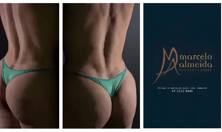 Notícias  Dr. Marcelo Almeida revoluciona curvas com técnica híbrida