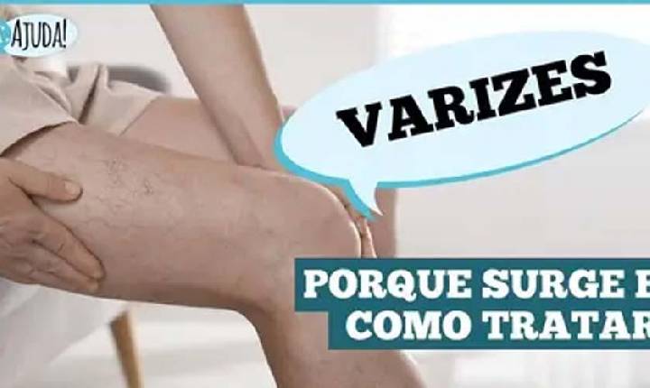 VÍDEO - Varizes: não é só estética é saúde vascular