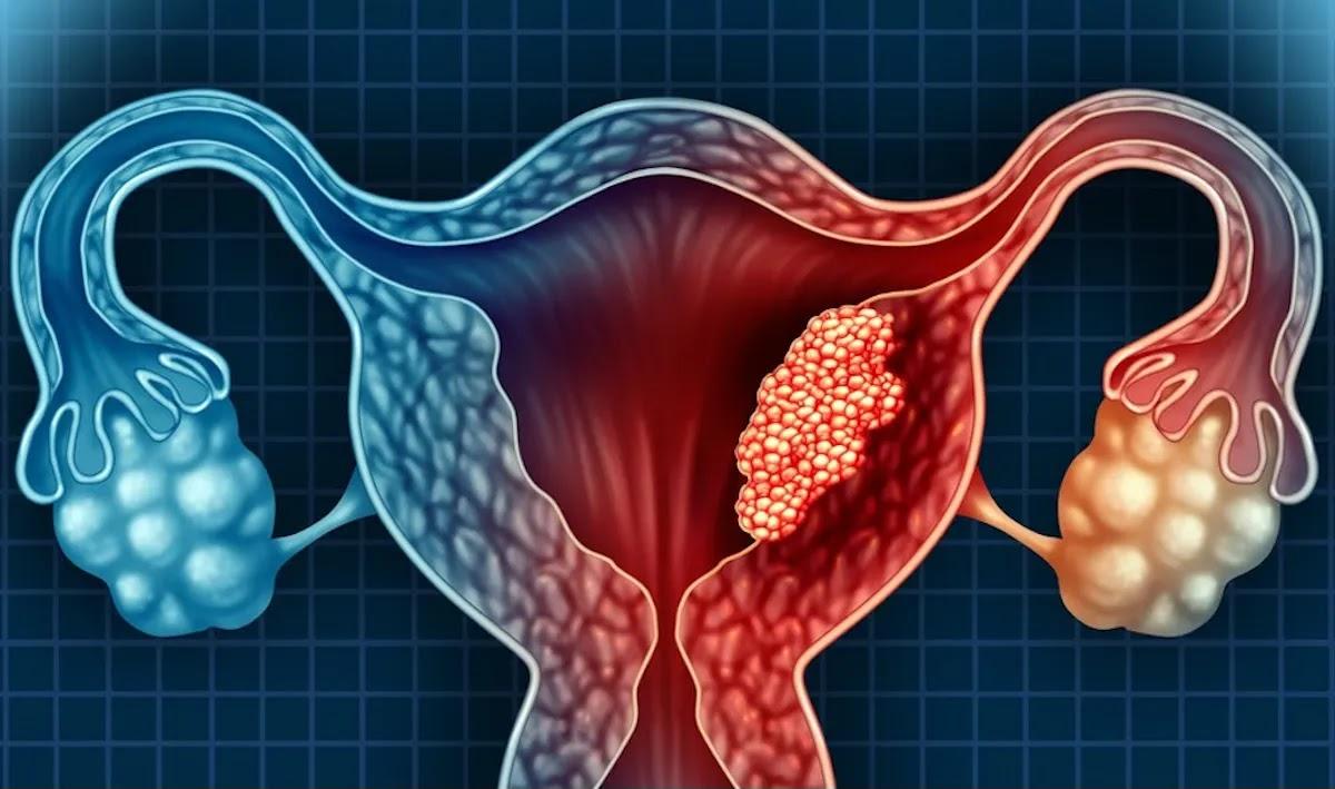 Endometriose pode ser a causa de 40% dos casos de infertilidade