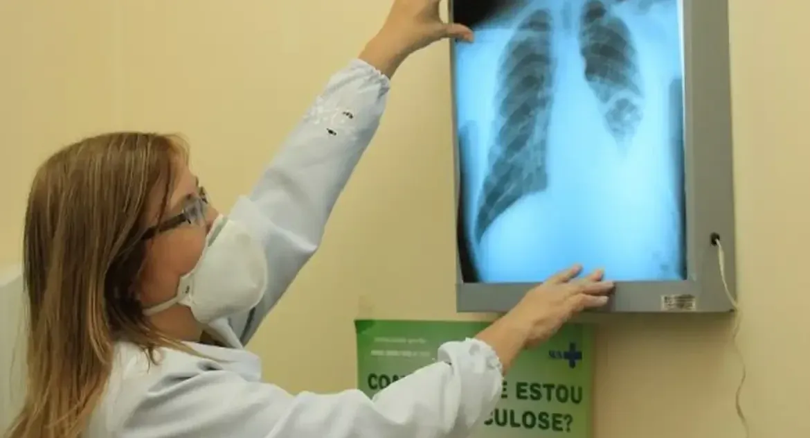Saúde - OMS alerta para o baixo financiamento no combate à tuberculose