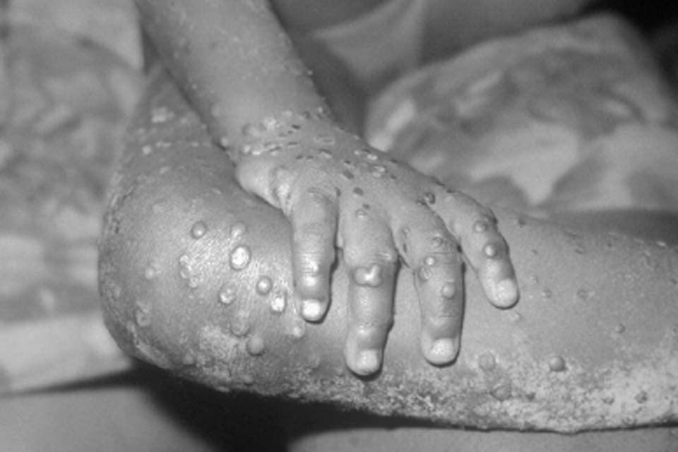 SAÚDE Mpox: África tem quase 50 mil casos confirmados