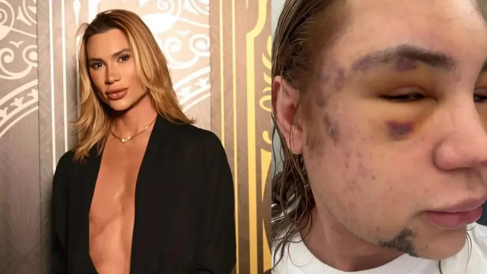 Influenciador Junior Dutra morre após procedimento estético malsucedido