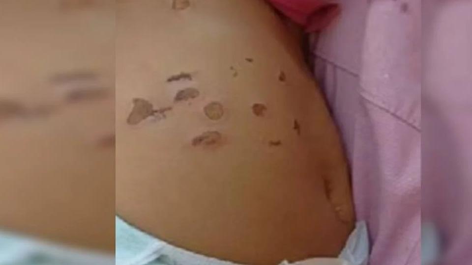 Plantão de Polícia -  Menina de 10 meses foi queimada por cigarros na barriga e nas pernas