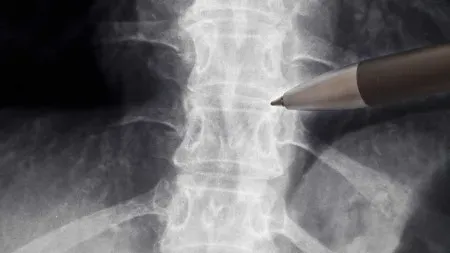 Anvisa libera estudo com medicamento para lesões na medula espinhal