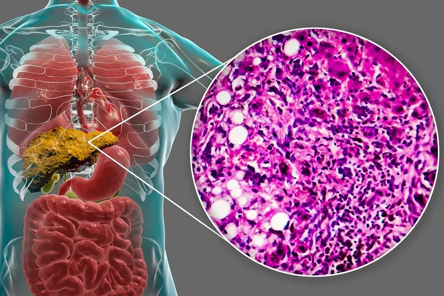 Nutrição - Gordura no fígado: nutricionista revela o alimento vilão do órgão