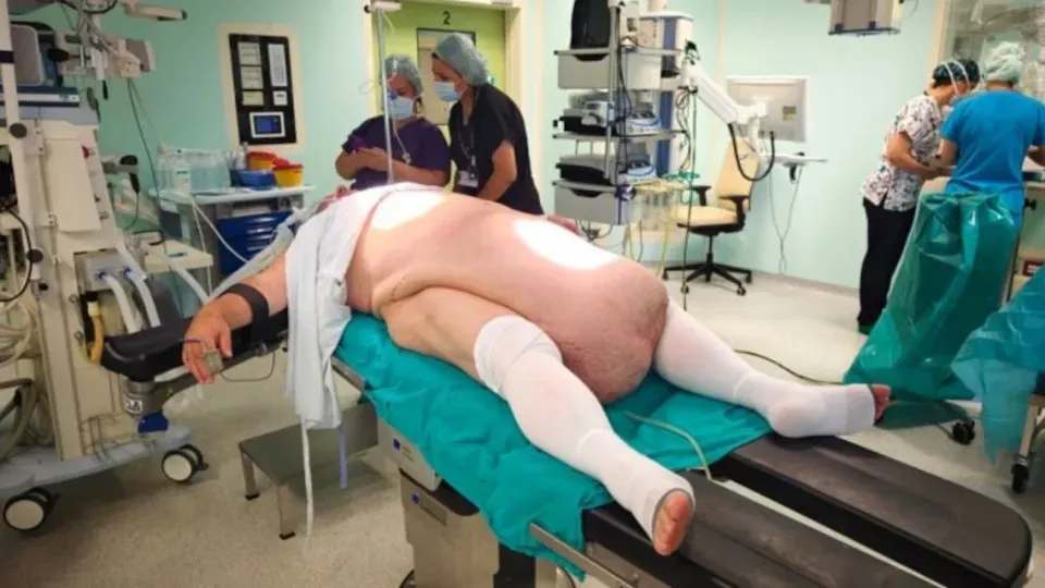 Tumor abdominal de 35 kg impede homem de urinar e choca médicos