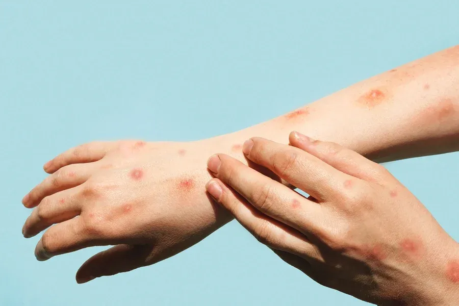 Saúde  -O que é mpox? Infectologista explica como reconhecer os sintomas