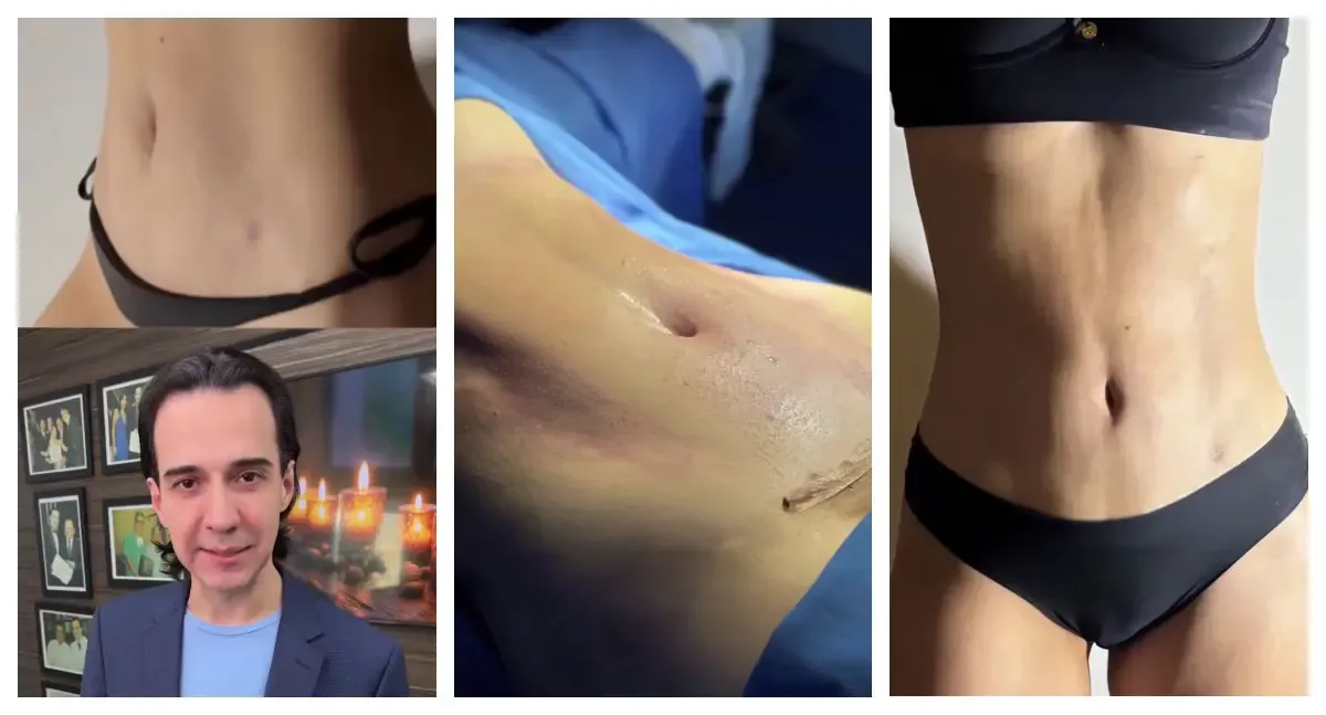 Notícias - Dr. Marcelo Almeida explica abdominoplastia com cicatriz reduzida