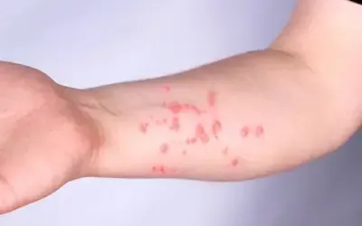 Saúde | Mpox -  Mpox: Brasil registra 140 casos em 2026