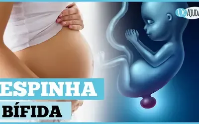 VÍDEO - Dr. Ajuda | Dr. Ajuda! - O que é e como prevenir a mielomeningocele?