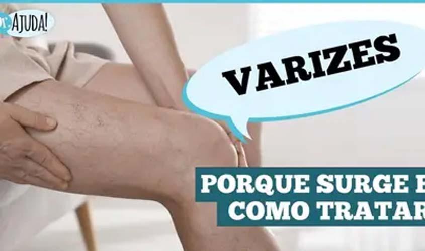 VÍDEO - Varizes: não é só estética é saúde vascular