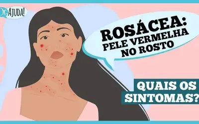 Dr. Ajuda | Saúde - Rosácea: o que é e quais são os sintomas
