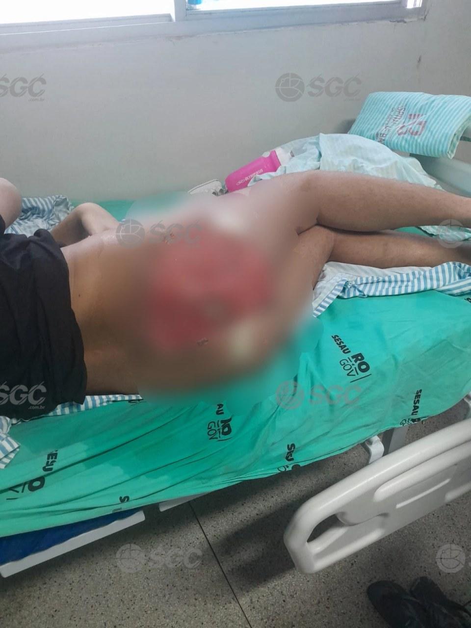 Rondônia - Sesau se pronuncia sobre caso de paciente com complicações por silicone industrial