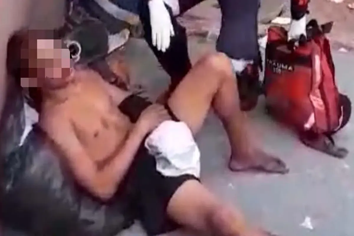 Violencia - Morador de rua tem os dois braços quebrados durante espancamento